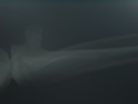 
            X-ray of Exostosis
          